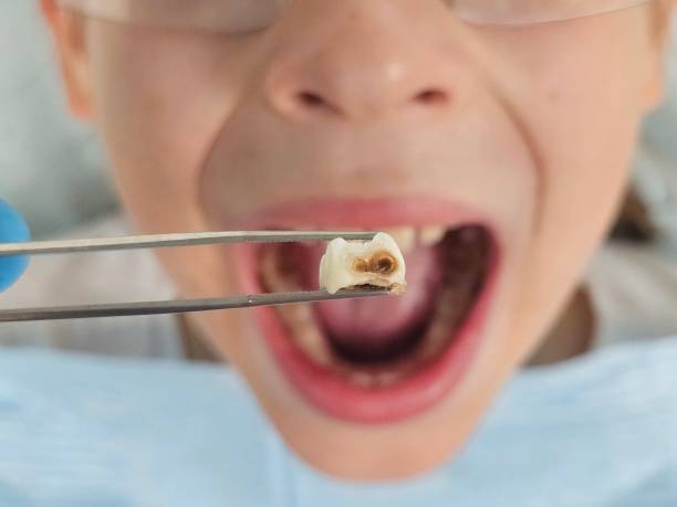 Best Emergency Dentist for Lost Fillings or Crowns in Riverwoods, IL